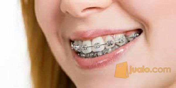 Behel gigi kualitas PLATINUM ortho