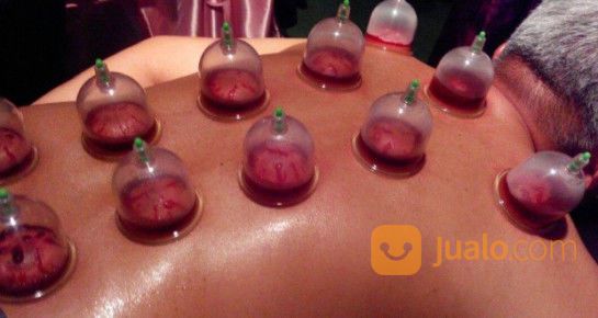 Terapi Bekam Di Rumah/ Homecare Bekam Medis Untuk Kesehatan