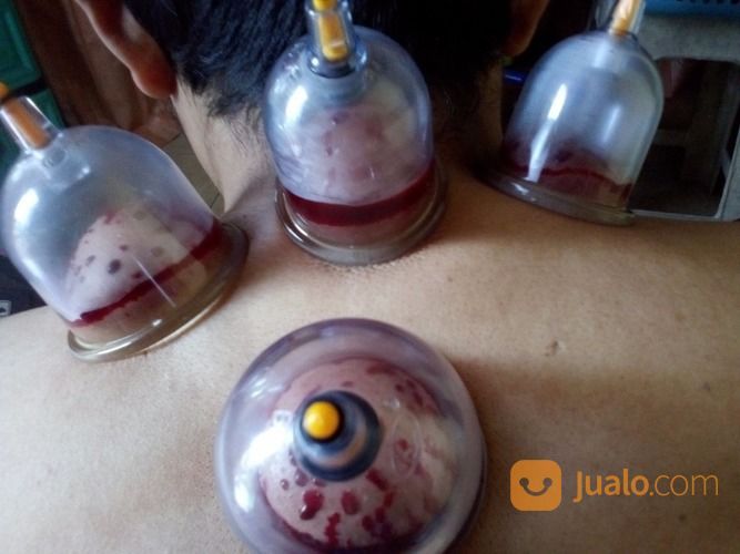 Jasa Bekam Tasikmalaya Kawalu