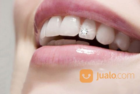 Pasang Diamond Gigi
