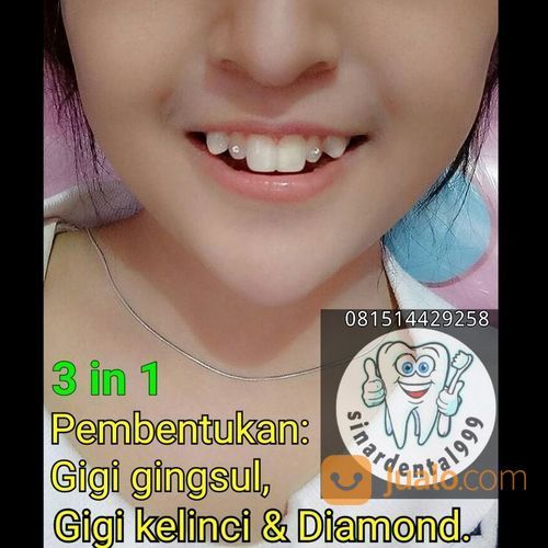 Gigi Kelinci, Gigi Gingsul, Diamond.