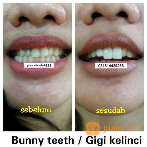 Gigi Kelinci, Gigi Gingsul, Diamond.