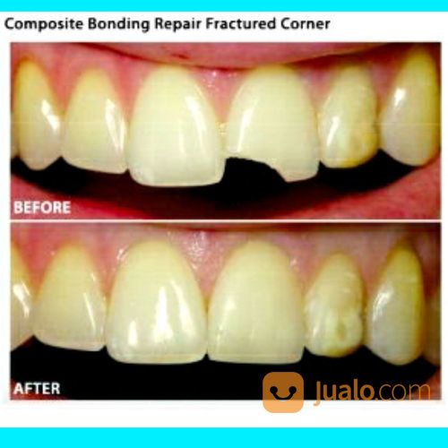 Gigi Kelinci, Gigi Gingsul, Diamond.