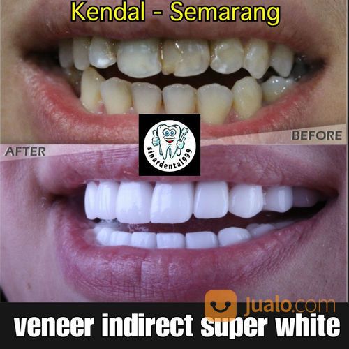 Gigi Kelinci, Gigi Gingsul, Diamond.