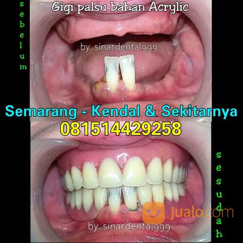 Pasang Gigi Tiruan / Dentur
