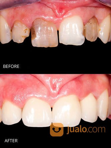 Pasang Gigi Tiruan / Dentur