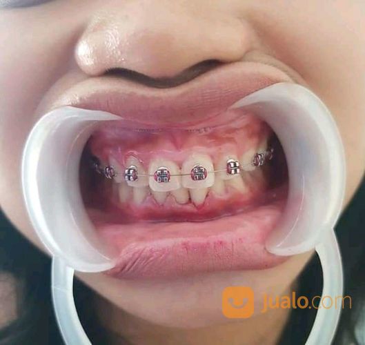 Pasang Behel/Kawat Gigi