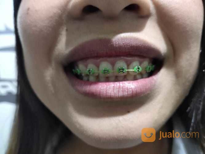 Pasang Behel/Kawat Gigi