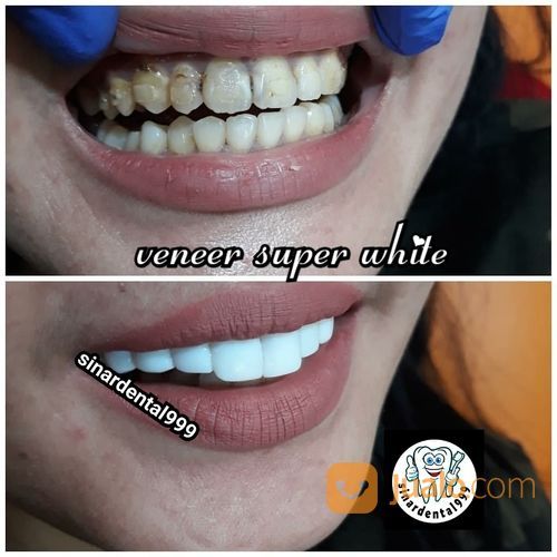 Veneer Super White