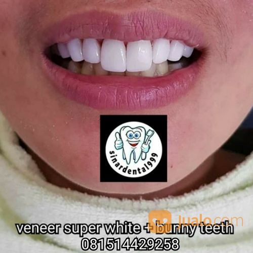 Veneer Super White