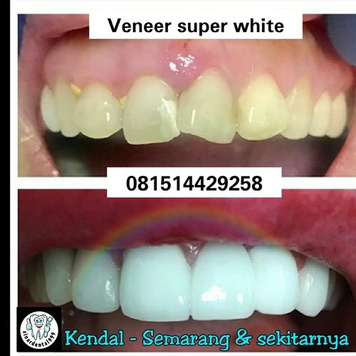 Veneer Super White