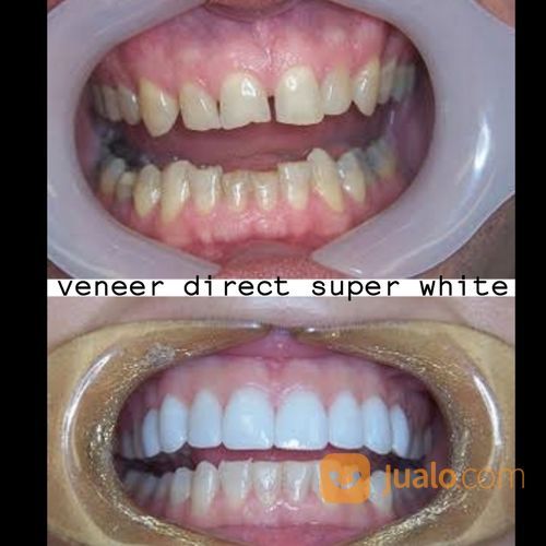 Veneer Super White