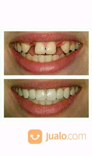 Tukang Gigi Palsu Panggilan Di Purwokerto, Purbalingga, Banyumas, Ajibarang, Wangon Murah Berkualitas.