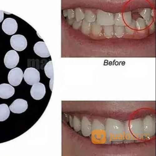 Tukang Gigi Palsu Panggilan Di Purwokerto, Purbalingga, Banyumas, Ajibarang, Wangon Murah Berkualitas.