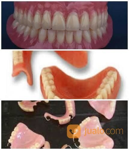 Tukang Gigi Palsu Panggilan Di Purwokerto, Purbalingga, Banyumas, Ajibarang, Wangon Murah Berkualitas.