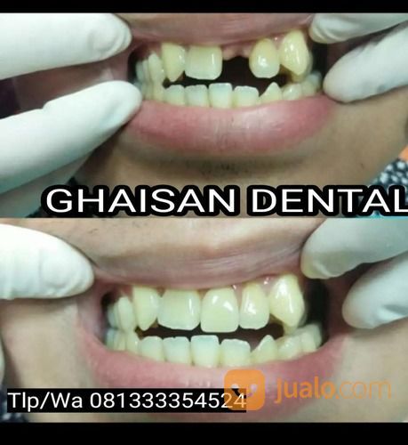 MELAYANI PEMASANGAN GIGI PALSU