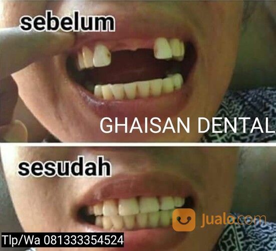 MELAYANI PEMASANGAN GIGI PALSU