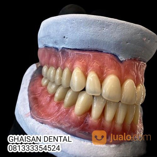MELAYANI PEMASANGAN GIGI PALSU