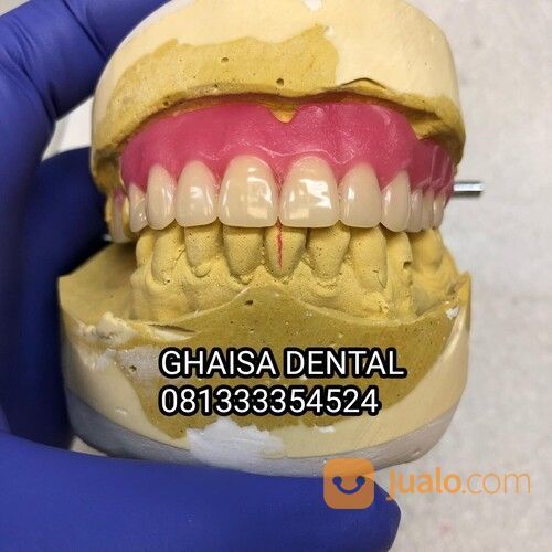 MELAYANI PEMASANGAN GIGI PALSU