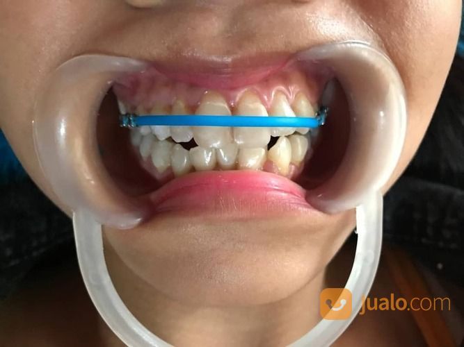 Behel Thailand Behel Lepas Pasang Thailand