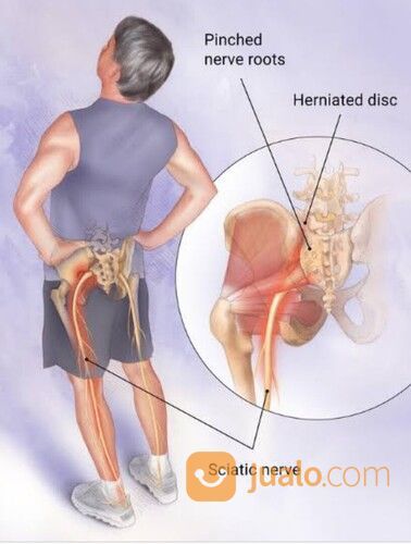 SARAF KEJEPIT / SAKIT PINGGANG (HNP)