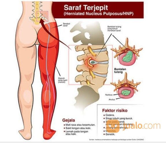 SARAF KEJEPIT / SAKIT PINGGANG (HNP)