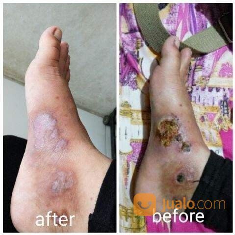 Obat Diabetes Melitus Diabetes Insipidus Kencing Manis Ampuh