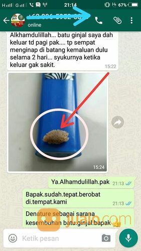 Salah Satu Cara Mengatasi Batu Ginjal Dengan Bahan Alami Tanpa Operasi Sesuai Saran Dokter
