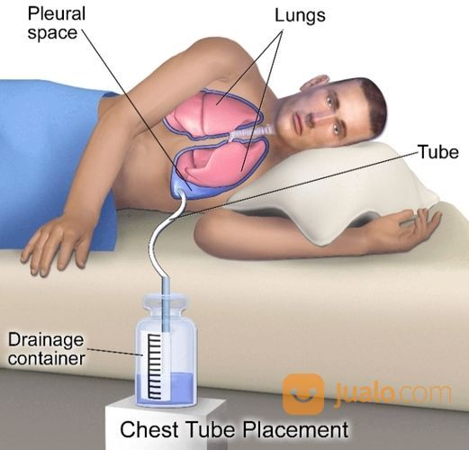 Perawatan Home Care Pasien Dengan Alat WSD/Pnuemothorax