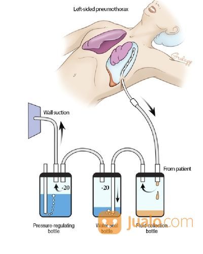 Perawatan Home Care Pasien Dengan Alat WSD/Pnuemothorax
