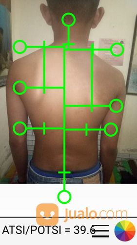 Chiropractic / Kretek - Kretek Atasi Masalah Tulang Belakang