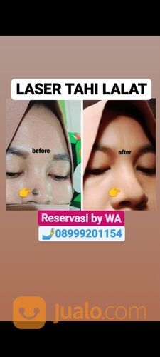 Laser hapus tat / ula / lek wajah terbagus