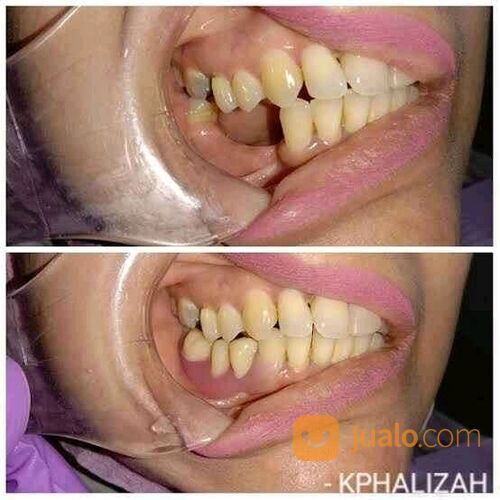 Valplast Gigi Palsu Lentur