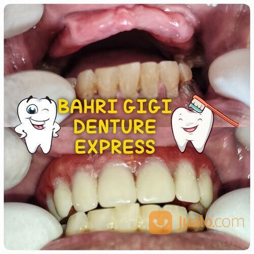 Pasang Gigi Palsu Lepasan