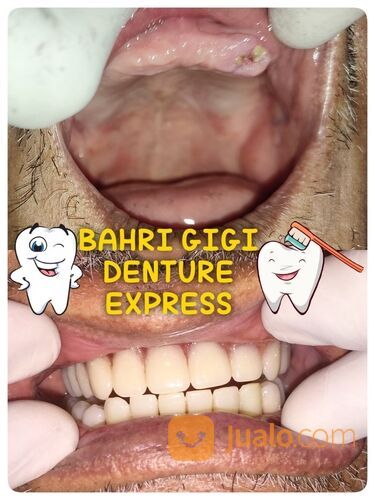 Pasang Gigi Palsu Lepasan