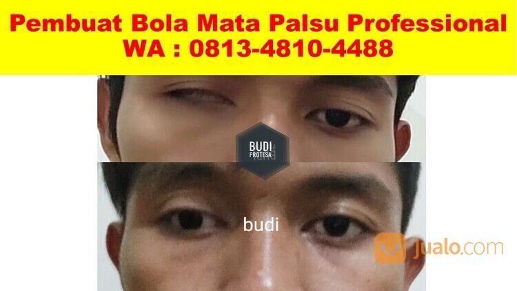 Bisa Custom! Wa : 0813-4810-4488, Pembuat Protesa Mata Bagus Budi Protesa Gresik