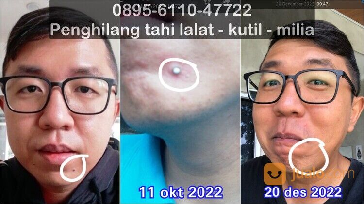 0895-6110-47722, Obat Penghilang Tahi Lalat Tanpa Bekas Terdekat di Bandung Tanpa Laser