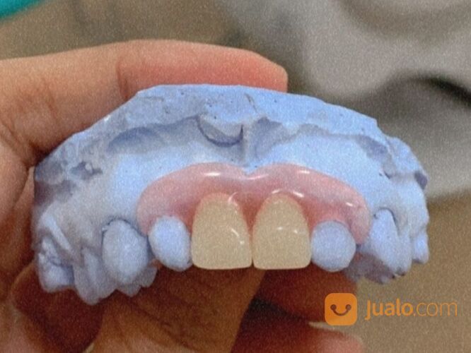 Pasang Gigi Valplast