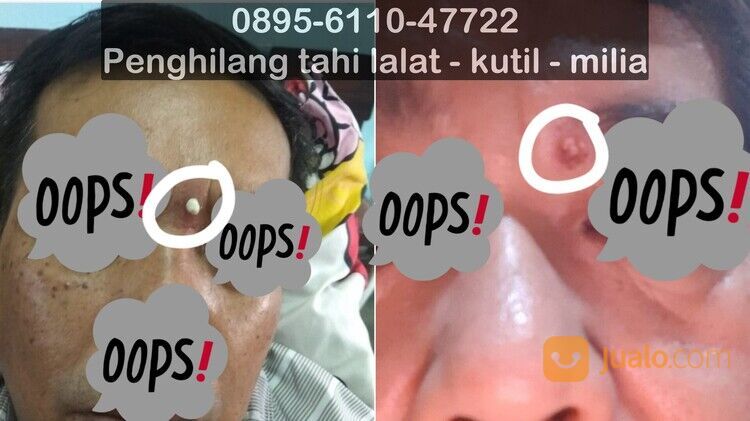 0895-6110-47722, Jasa Menghilangkan Tahi Lalat Bandung bisa Datang ke Rumah