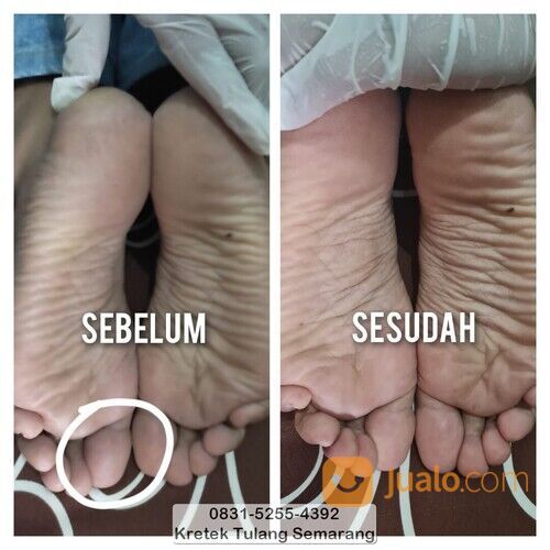 0831-5255-4392, Bone Setting Semarang - Tempat Pengobatan Syaraf Kejepit di Semarang