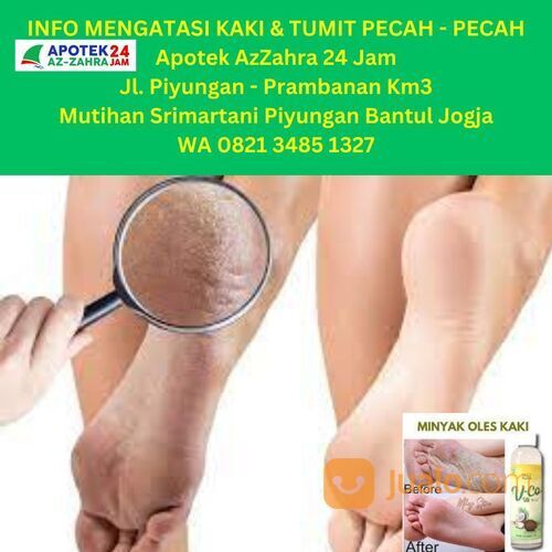 TERDEKAT, 0821-3485-1327 Manjur Obat Tumit Pecah-Pecah Di Apotik Apotek AzZahra 24 Jam