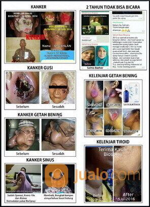BIO SPRAY TERBUKTI MEMBANTU PENYEMBUHAN PENYAKIT KRONIS