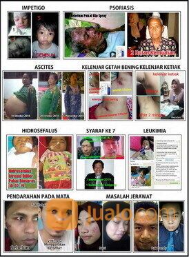 BIO SPRAY TERBUKTI MEMBANTU PENYEMBUHAN PENYAKIT KRONIS